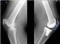 La rotule, l'Achille de la prothèse totale de genou