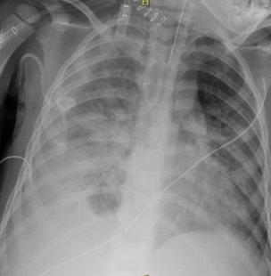 Images radiographiques à J0 (a), J8 (b) et tomodensitométrique à J10 (c) de pneumopathie nécrosante droite chez un enfant de 3 ans