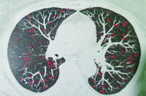 Micronodules calcifiés visualisés au scanner thoracique liés à une séquelle de pneumopathie varicelleuse.