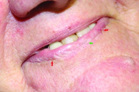 Cliché 1 : Chéilite actinique de la lèvre inférieure (flèche verte), et deux zones ulcérées (flèches rouges) correspondant à une transformation maligne en carcinome épidermoïde.