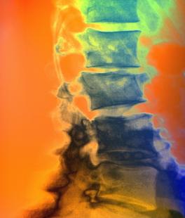 Radiographie de la colonne vertébrale d'une patiente atteinte d'ostéoporose.