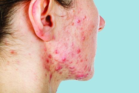 L’acné, une maladie du microbiote cutané