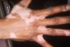 Journées dermatologiques de Paris : entre avancées dans le vitiligo et inquiétudes sur les IST