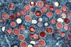 Une cinquantaine de cas de Mpox en France début 2024 : le virus circule à bas bruit