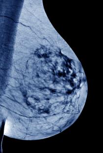 Les cancers HER2+ représentent environ 15 à 20 % des cas de cancer du sein