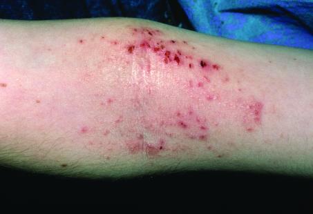 Dermatite atopique : vers des traitements proactifs
