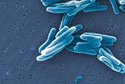 Un consensus sur la tuberculose aboutit à une nouvelle classification pour améliorer le diagnostic