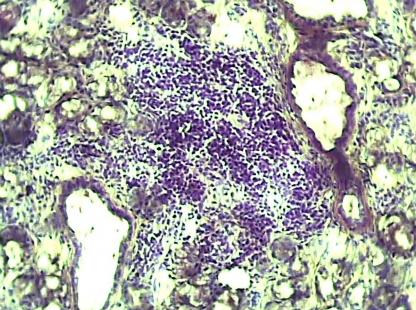 La cytokine BLyS est augmentée dans le syndrome de Sjögren primitif et joue un rôle dans l’hyperactivité des lymphocytes B