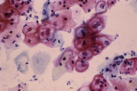 Cellules du col de l'utérus d'un frottis vaginal infectées par le HPV.
