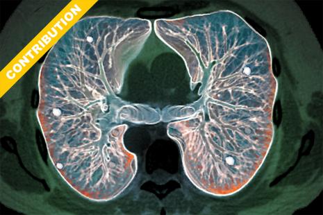 Dépistage du cancer du poumon : faut-il nier l'évidence ...