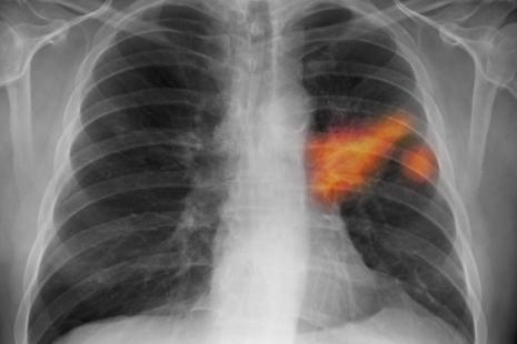 Cancer du poumon : que savent les Français de la maladie qu'ils ...