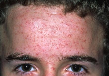 Deux applis pour mieux évaluer la sévérité de l'acné | Le ...