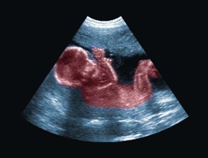 Echographie d'un foetus au troisième trimestre de grossesse.