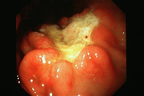 Selon l'Inca, 80 % des cas de cancer de l'estomac sont liés à Helicobacter pylori