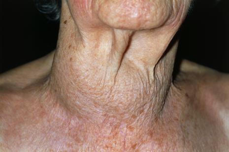 Cancer de la thyroïde à faible risque : l'iode radioactif n ...