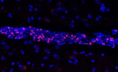 Image fluorescente d’un tissu cérébral humain post-mortem. Les noyaux cellulaires (bleu) mettent en évidence un vaisseau sanguin dans lequel les cellules endothéliales vasculaires expriment le matériel génétique du SARS-CoV-2 (rouge)